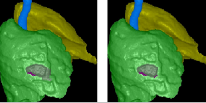 Medium lungs